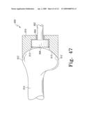 Customized Patient-Specific Multi-Cutting Blocks diagram and image