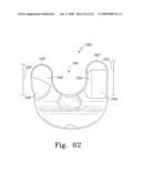 Customized Patient-Specific Multi-Cutting Blocks diagram and image