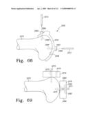 Customized Patient-Specific Multi-Cutting Blocks diagram and image