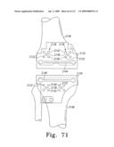 Customized Patient-Specific Multi-Cutting Blocks diagram and image