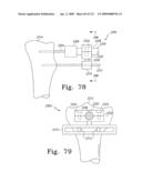 Customized Patient-Specific Multi-Cutting Blocks diagram and image