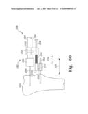 Customized Patient-Specific Multi-Cutting Blocks diagram and image