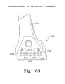 Customized Patient-Specific Multi-Cutting Blocks diagram and image