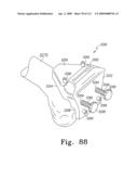 Customized Patient-Specific Multi-Cutting Blocks diagram and image