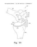 Customized Patient-Specific Multi-Cutting Blocks diagram and image