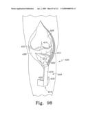 Customized Patient-Specific Multi-Cutting Blocks diagram and image