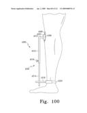 Customized Patient-Specific Multi-Cutting Blocks diagram and image