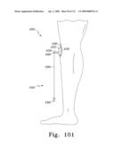 Customized Patient-Specific Multi-Cutting Blocks diagram and image