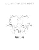 Customized Patient-Specific Multi-Cutting Blocks diagram and image