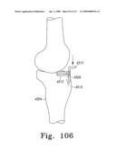 Customized Patient-Specific Multi-Cutting Blocks diagram and image