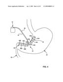 GASTRIC ELECTRICAL STIMULATION WITH MULTI-SITE STIMULATION ANTI-DESENSITIZATION FEATURE diagram and image
