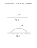 ADJUSTABLE ANNULOPLASTY RING AND ACTIVATION SYSTEM diagram and image