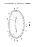 ADJUSTABLE ANNULOPLASTY RING AND ACTIVATION SYSTEM diagram and image