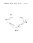 ADJUSTABLE ANNULOPLASTY RING AND ACTIVATION SYSTEM diagram and image