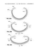 ADJUSTABLE ANNULOPLASTY RING AND ACTIVATION SYSTEM diagram and image