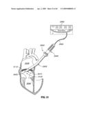 ADJUSTABLE ANNULOPLASTY RING AND ACTIVATION SYSTEM diagram and image