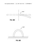 ADJUSTABLE ANNULOPLASTY RING AND ACTIVATION SYSTEM diagram and image