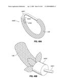 ADJUSTABLE ANNULOPLASTY RING AND ACTIVATION SYSTEM diagram and image