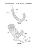 ADJUSTABLE ANNULOPLASTY RING AND ACTIVATION SYSTEM diagram and image