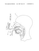 Guide device for tracheal intubation diagram and image