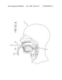 Guide device for tracheal intubation diagram and image