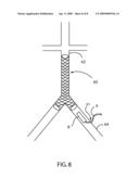 Intravascular Stapling Tool diagram and image