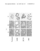 Grading of Breast Cancer diagram and image