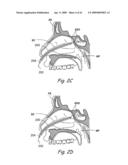 Devices, Systems and Methods Useable for Treating Sinusitis diagram and image