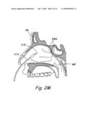 Devices, Systems and Methods Useable for Treating Sinusitis diagram and image