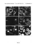 UPREGULATION OF RACK-1 IN MELANOMA AND ITS USE AS A MARKER diagram and image