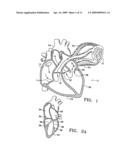 DEVICE TO PERMIT OFFPUMP BEATING HEART CORONARY BYPASS SURGERY diagram and image