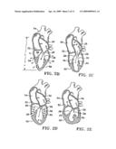 DEVICE TO PERMIT OFFPUMP BEATING HEART CORONARY BYPASS SURGERY diagram and image