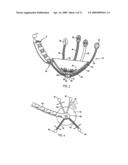 DEVICE TO PERMIT OFFPUMP BEATING HEART CORONARY BYPASS SURGERY diagram and image