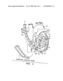 DEVICE TO PERMIT OFFPUMP BEATING HEART CORONARY BYPASS SURGERY diagram and image