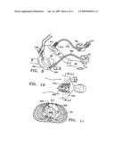 DEVICE TO PERMIT OFFPUMP BEATING HEART CORONARY BYPASS SURGERY diagram and image