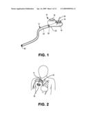 IMPLANTABLE CATHETER PORT diagram and image