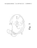 Customized Patient-Specific Bone Cutting Blocks diagram and image