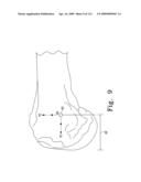 Customized Patient-Specific Bone Cutting Blocks diagram and image