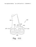 Customized Patient-Specific Bone Cutting Blocks diagram and image