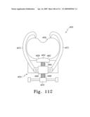 Customized Patient-Specific Bone Cutting Blocks diagram and image