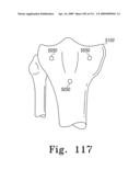 Customized Patient-Specific Bone Cutting Blocks diagram and image