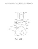 Customized Patient-Specific Bone Cutting Blocks diagram and image