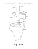 Customized Patient-Specific Bone Cutting Blocks diagram and image