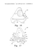 Customized Patient-Specific Bone Cutting Blocks diagram and image