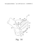 Customized Patient-Specific Bone Cutting Blocks diagram and image