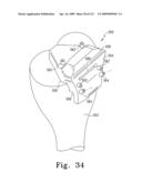 Customized Patient-Specific Bone Cutting Blocks diagram and image