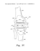 Customized Patient-Specific Bone Cutting Blocks diagram and image