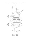 Customized Patient-Specific Bone Cutting Blocks diagram and image