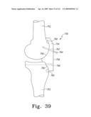 Customized Patient-Specific Bone Cutting Blocks diagram and image