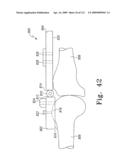 Customized Patient-Specific Bone Cutting Blocks diagram and image